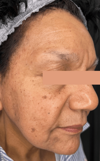 Laser Resurfacing