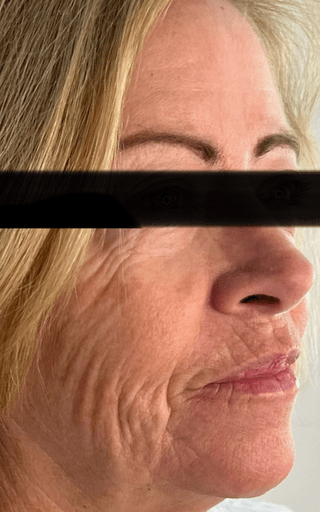 Rf-Microneedling