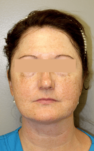 Laser Resurfacing