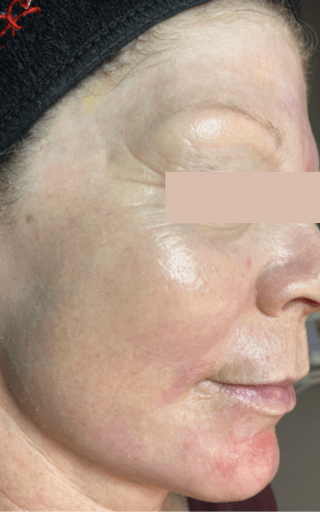 Laser Resurfacing