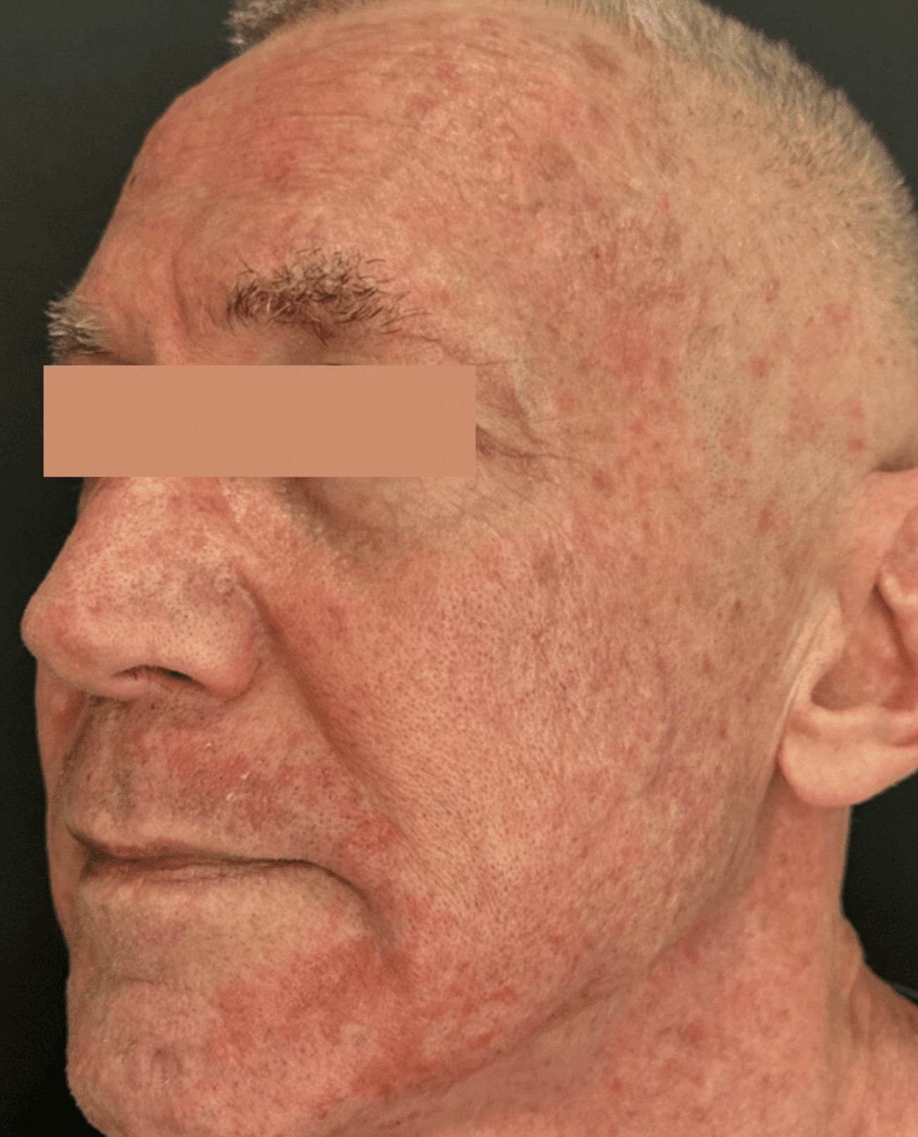 Pigmented Lesions
