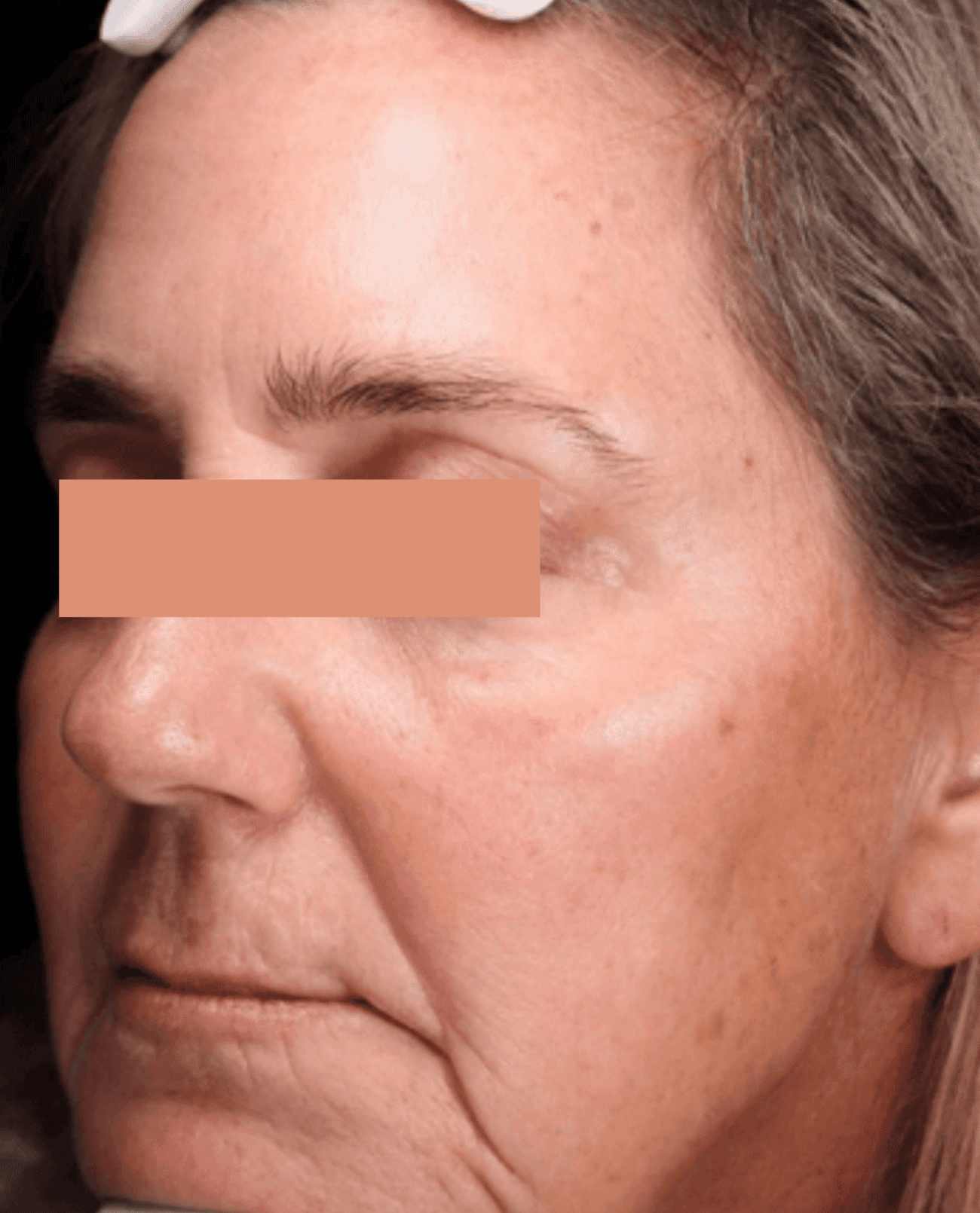 Skin Rejuvenation