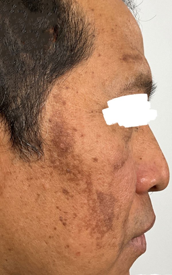 Vascular/Rosacea Treatments