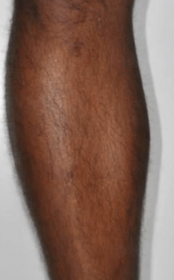 Laser Hair Removal with MotusAZ+