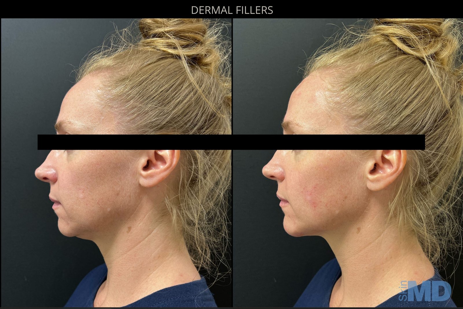 CHIN-FILLER-2024-scaled