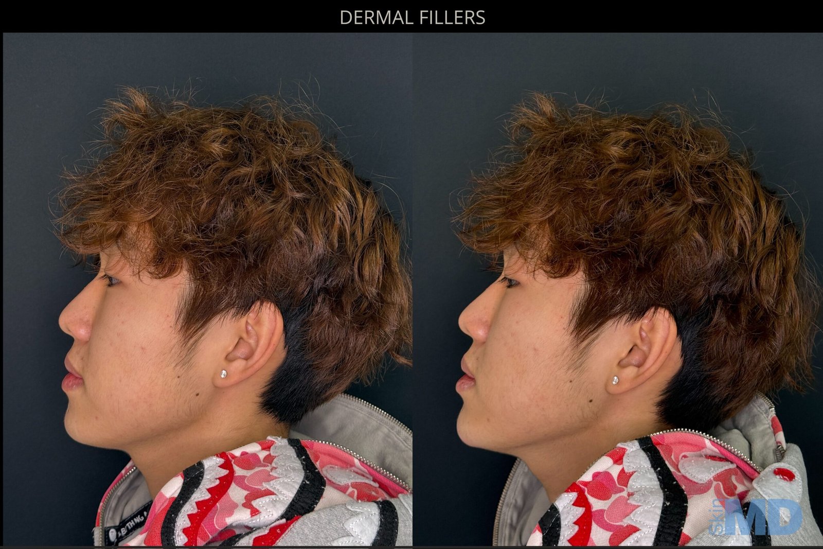 CHIN-FILLER-BB-12.4-scaled