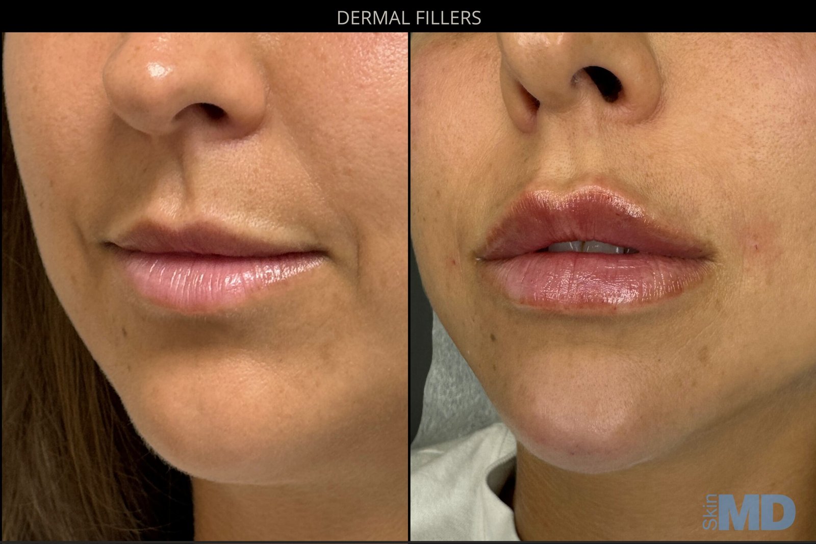 JULY-LIP-MEL-2-scaled