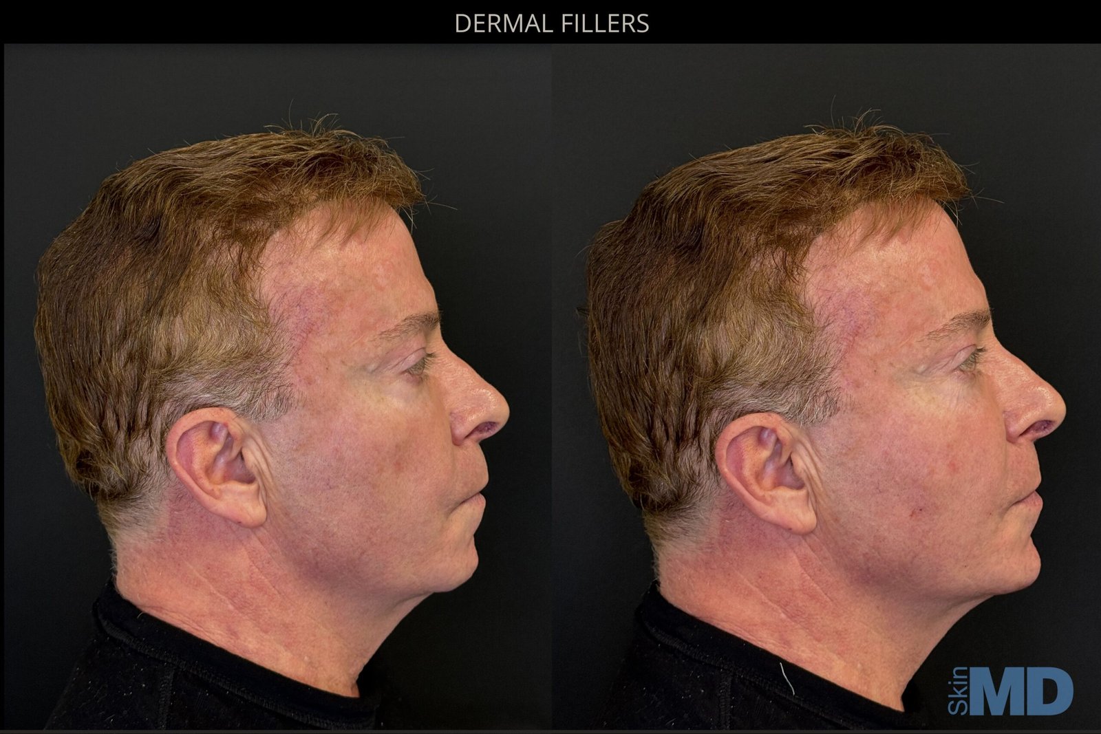 MALE-CHIN-FILLER-BB--scaled
