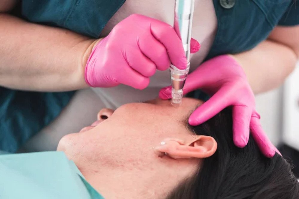 Microneedling Small. 1 jpg Microneedling
