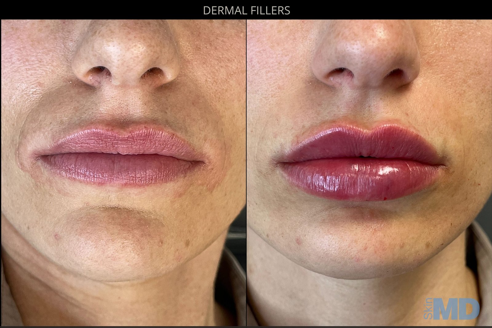 SHANLEY-X-NADIA-LIP-scaled