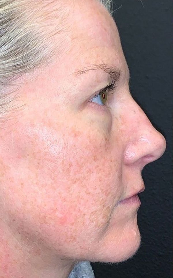 Vascular/Rosacea Treatments