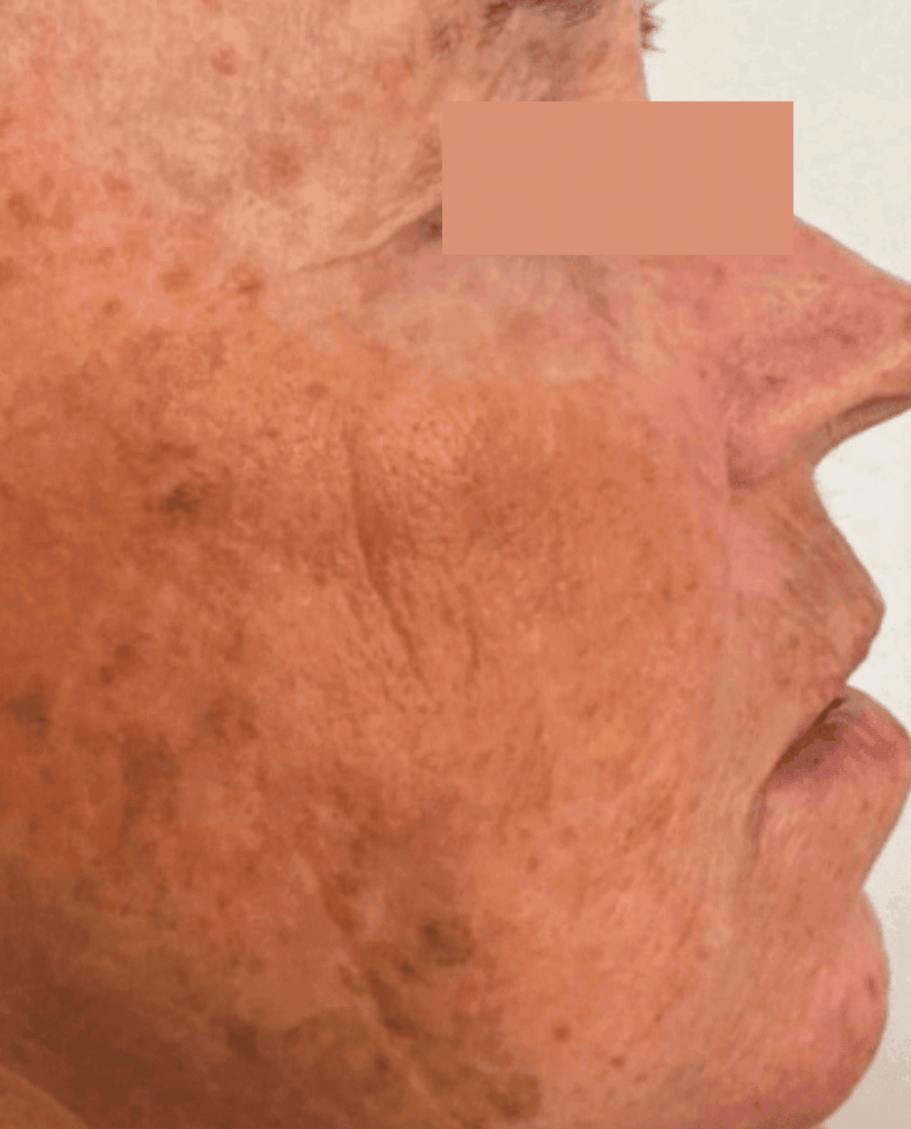 Pigmented Lesions