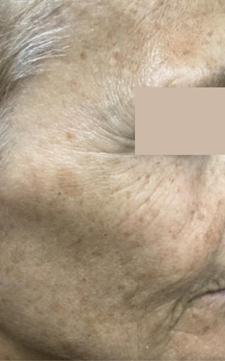 Vascular/Rosacea Treatments