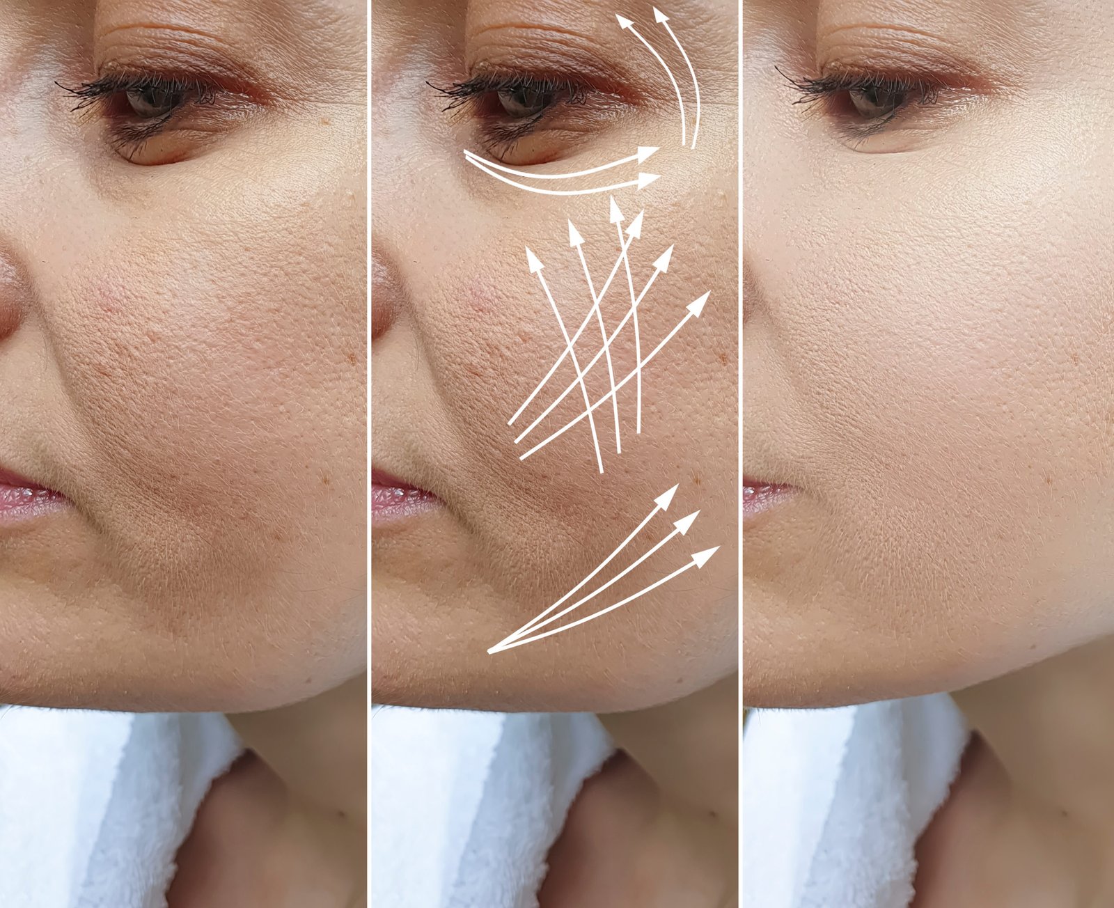 Skin Tightening + Rejuvenation