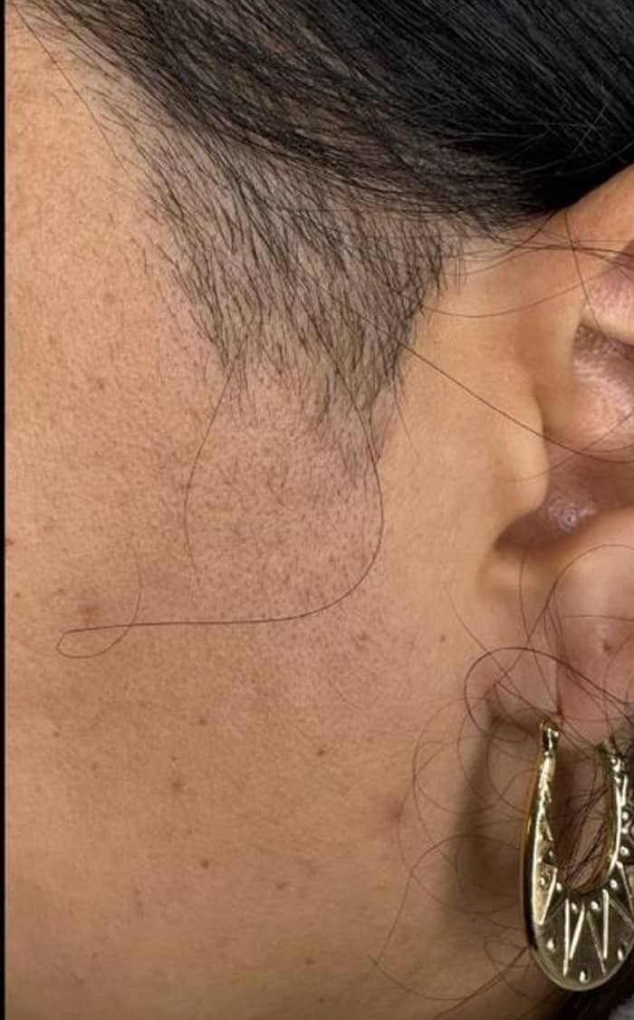 Laser Hair Removal with MotusAZ+