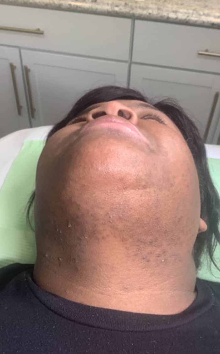 Laser Hair Removal with MotusAZ+