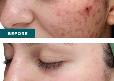 Chemical Peels