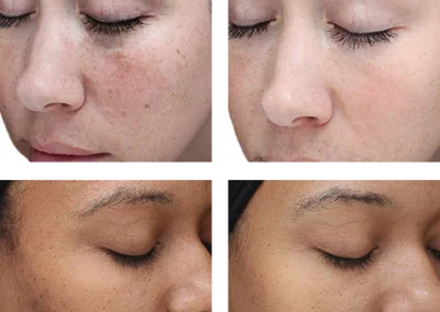 Chemical Peels