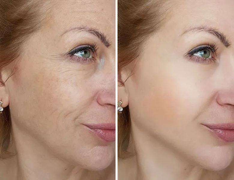 Skin Resurfacing